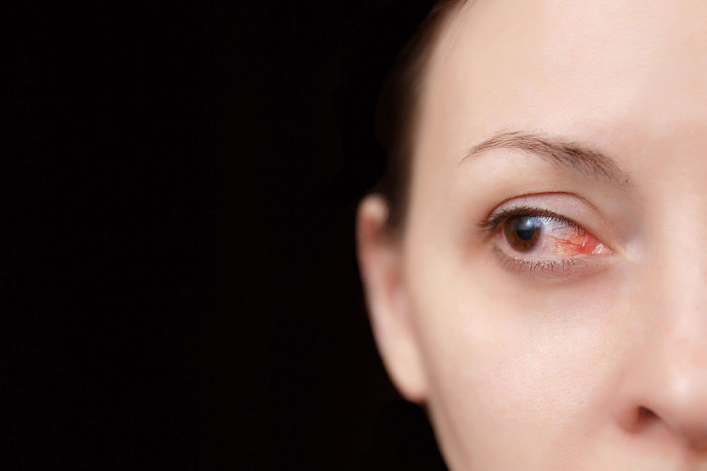 red eye evaluation and treatment